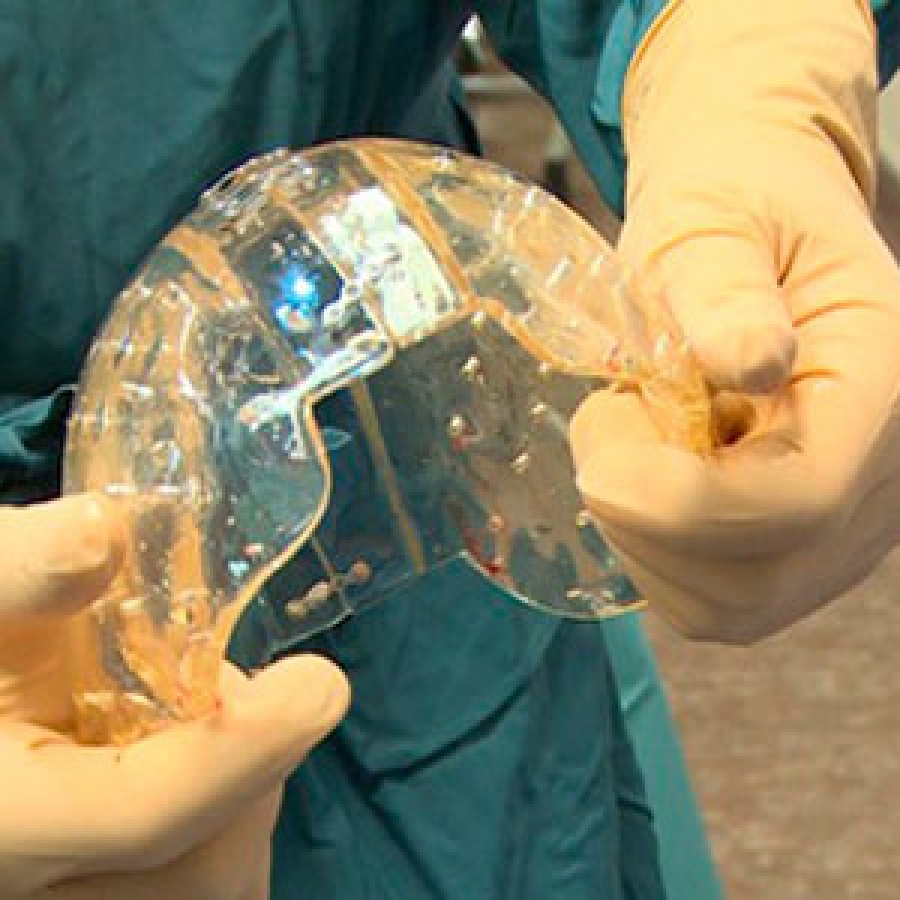 Trasplantan un cráneo impreso en 3D a una niña con hidrocefalia